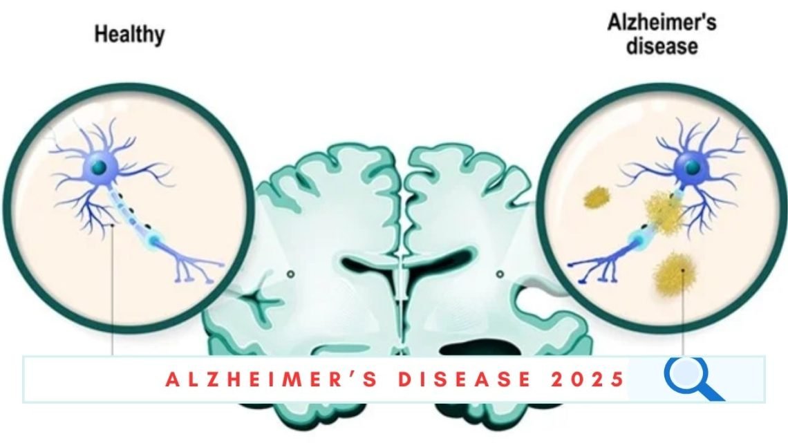 alzheimer's disease 2025
