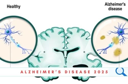 alzheimer's disease 2025
