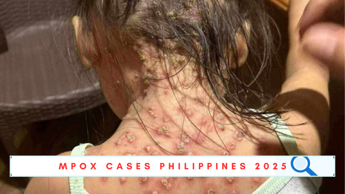 mpox cases philippines 2025