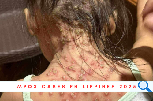 mpox cases philippines 2025