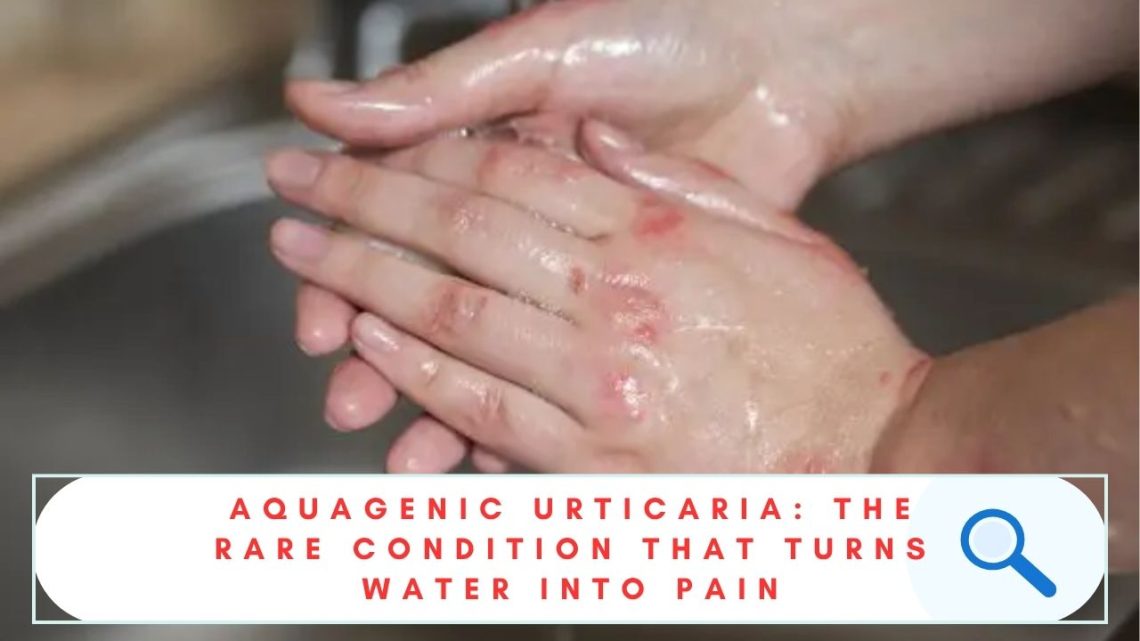 AQUAGENIC URTICARIA