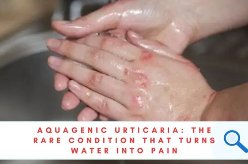 AQUAGENIC URTICARIA