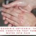 AQUAGENIC URTICARIA