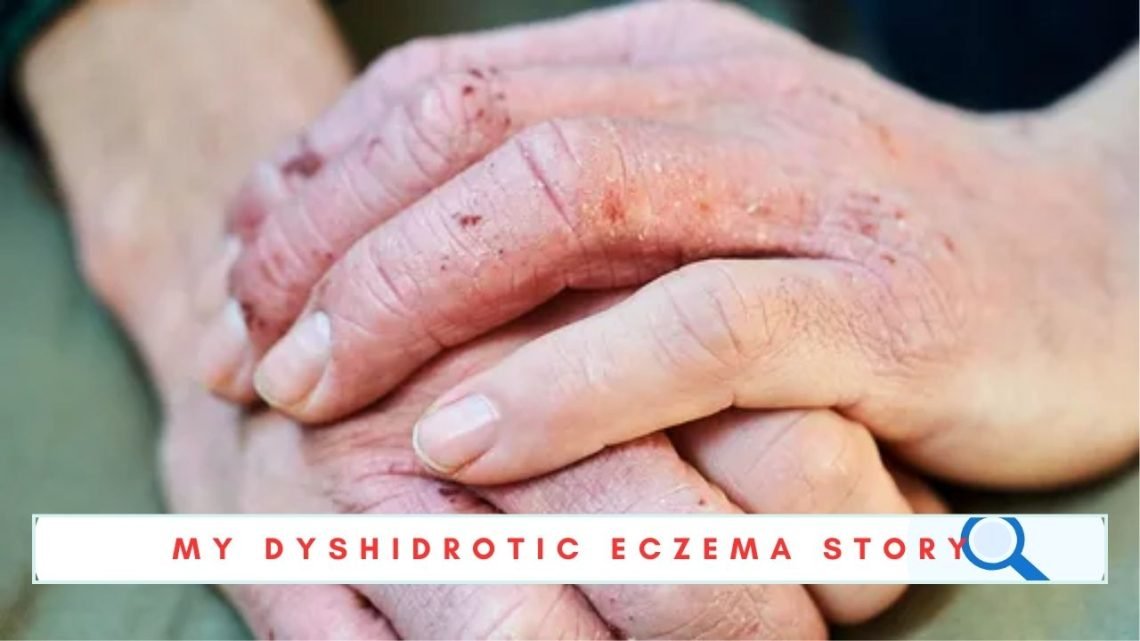 Dyshidrotic Eczema