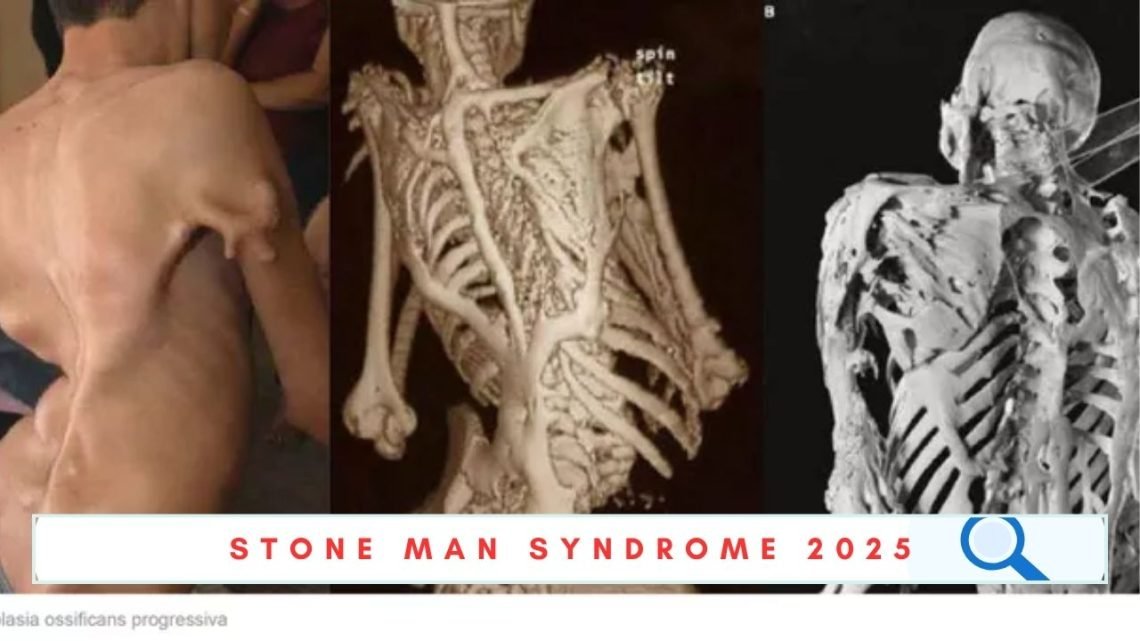 stone man syndrome