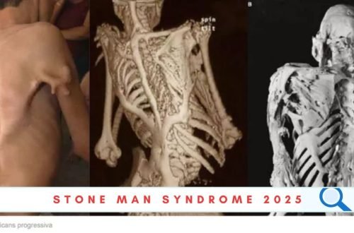stone man syndrome